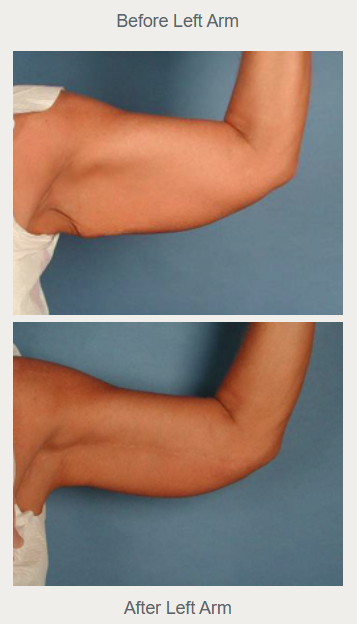 Historical left arm lift comparison, with before above and after below.