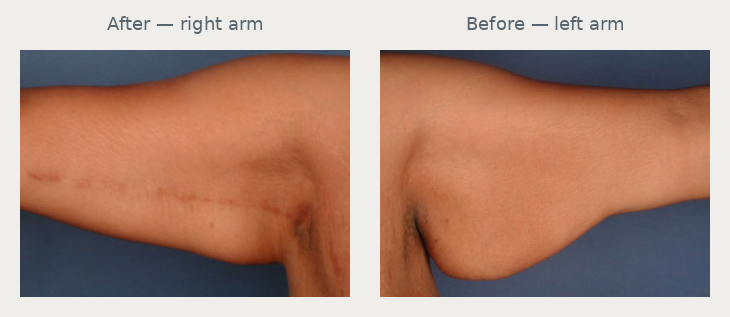 Historical arm photos: right arm after surgery at left and left arm before surgery at right. These are different arms.