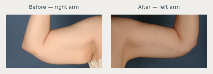 Historical arm photos: right arm before surgery at left and left arm after surgery at right. These are different arms.