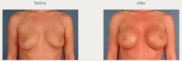 Historical breast augmentation comparison with the before photograph on the left and after photograph on the right.
