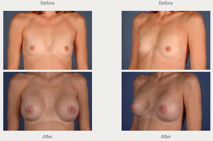 Historical breast augmentation comparison from front and angled views, with before photographs above after photographs.