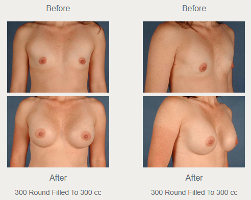 Front and angled breast augmentation comparisons labeled 300 round implants filled to 300 cc, with before photographs above after photographs.