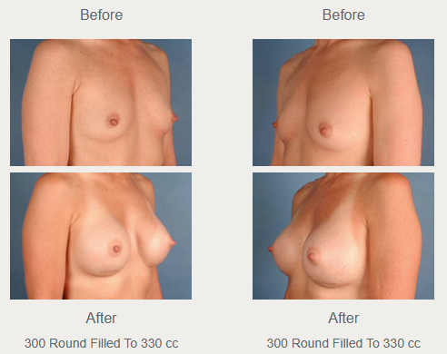 Angled breast augmentation comparisons labeled 300 round implants filled to 330 cc, with before photographs above after photographs.