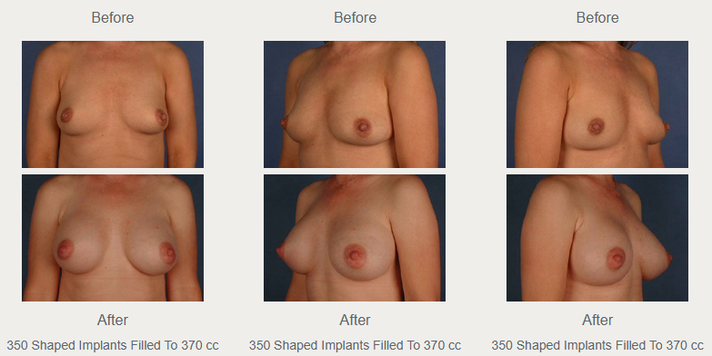 Three breast augmentation views labeled 350 shaped implants filled to 370 cc, with before photographs above after photographs.