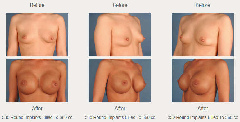 Three breast augmentation views labeled 330 round implants filled to 360 cc, with before photographs above after photographs.