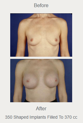 Front breast augmentation comparison labeled 350 shaped implants filled to 370 cc, with before above after.