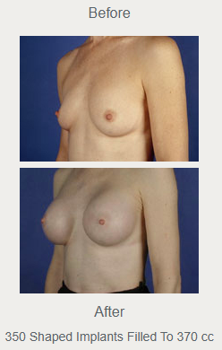 Angled breast augmentation comparison labeled 350 shaped implants filled to 370 cc, with before above after.