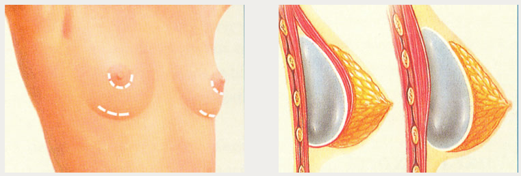 Historical illustration of breast implant incision locations and placement relative to the chest muscle.