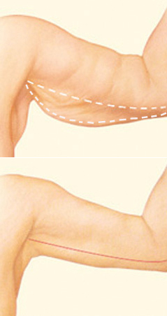 Original arm-lift illustration showing marked excess skin above and a possible scar below.