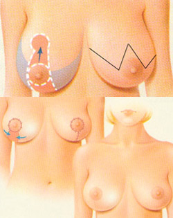 Original multi-panel illustration of breast reduction and breast reshaping.