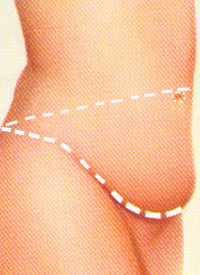 Original side-view abdominal illustration with dotted markings for a tummy tuck.
