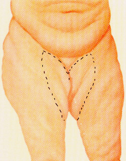 Original inner-thigh illustration with markings, paired with thigh lift in the historical page.