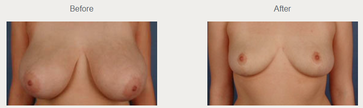 Historical breast reduction photographs showing the before view on the left and after view on the right