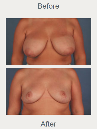 Historical breast reduction photographs with the before view above the after view