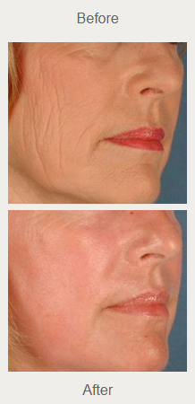 Historical traditional CO2 resurfacing photographs of the cheek and lower face, before above and after below.
