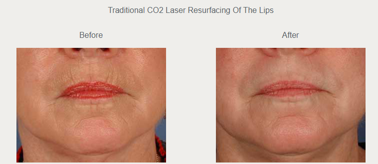 Historical traditional CO2 resurfacing photographs around the mouth, before on the left and after on the right.