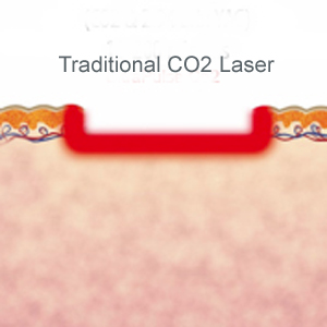 Historical cross-section illustration of traditional CO2 laser resurfacing.