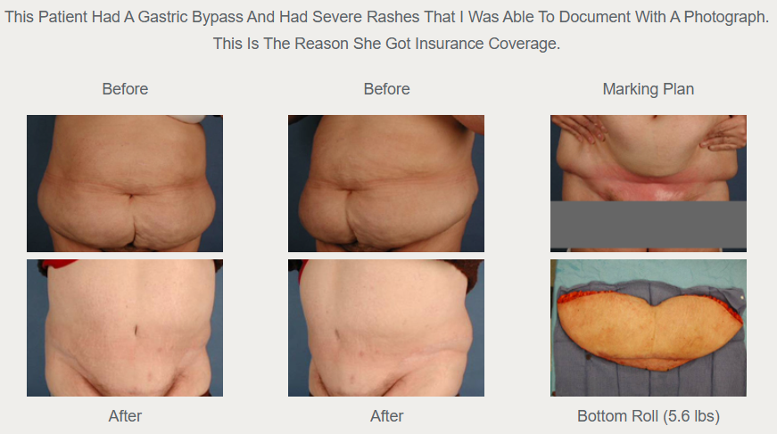 Historical comparison after gastric bypass, including skin irritation, a pre-existing privacy block, removed tissue, and an older caption about insurance coverage.