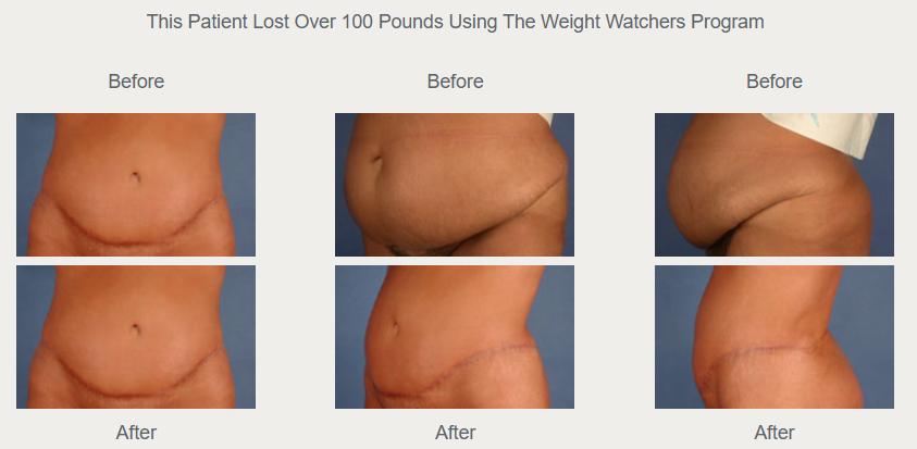 Historical comparison with before views above and after views below; the original caption reports weight loss of more than 100 pounds through Weight Watchers.