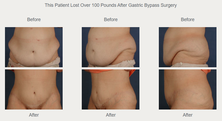 Historical comparison with before views above and after views below; the original caption reports weight loss of more than 100 pounds after gastric bypass.
