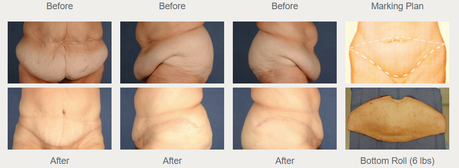Historical full tummy tuck comparison with three views, before above and after below, plus a marking diagram and removed-tissue photograph.