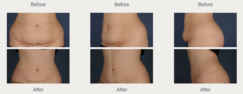 Historical full tummy tuck comparison with front and oblique views, before in the upper row and after in the lower row.