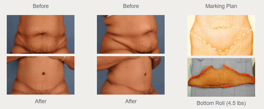 Historical full tummy tuck front and oblique comparisons, before above and after below, alongside a diagram and removed tissue.