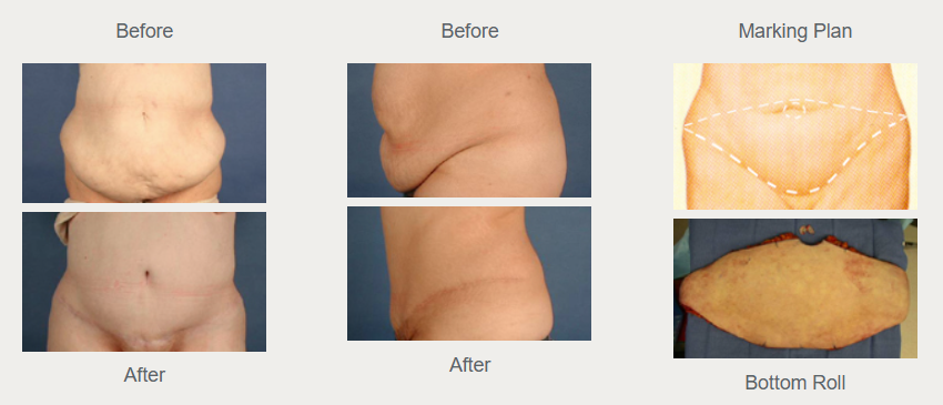 Historical full tummy tuck comparison showing abdominal contour before above and after below, with a marking diagram and removed tissue.