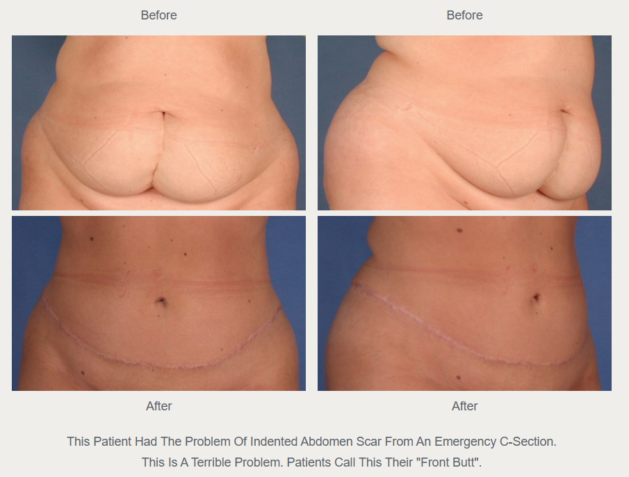 Historical front and oblique before-and-after comparison; the original caption describes an indented scar after an emergency C-section.