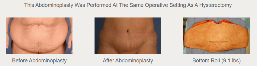 Historical comparison labeled as abdominoplasty with hysterectomy: before at left, after in the center, and removed tissue at right.