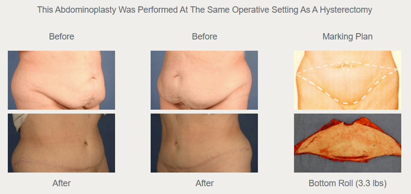 Second historical comparison labeled as abdominoplasty with hysterectomy, with before views above, after views below, and removed tissue at right.