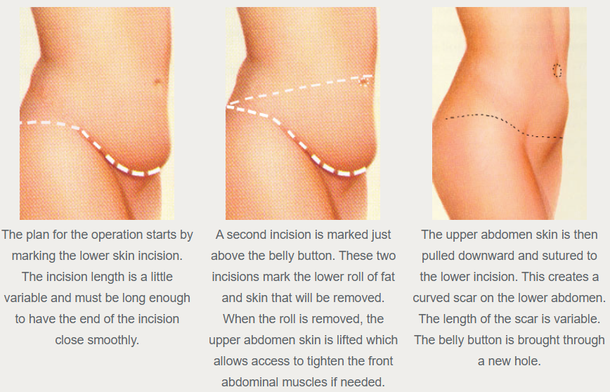 Original three-panel illustration of abdominal skin-removal markings, closure, and a new opening for the navel.