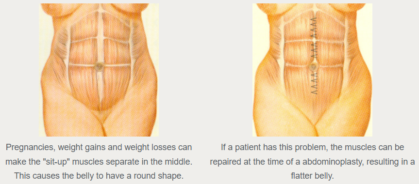 Original illustration of abdominal muscle separation and a repair, with historical explanatory captions.
