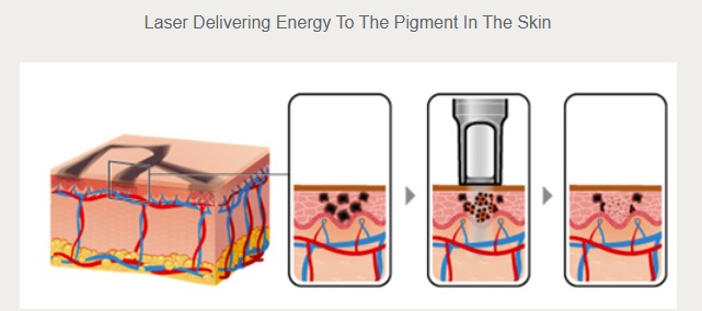 Historical diagram showing laser energy targeting tattoo pigment in the skin.