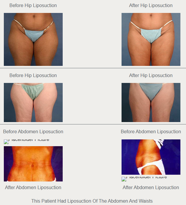 Two historical hip liposuction comparisons, each showing a before image on the left and an after image on the right.