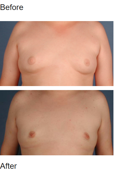 Supplied historical male breast reduction comparison showing front views before above and after below