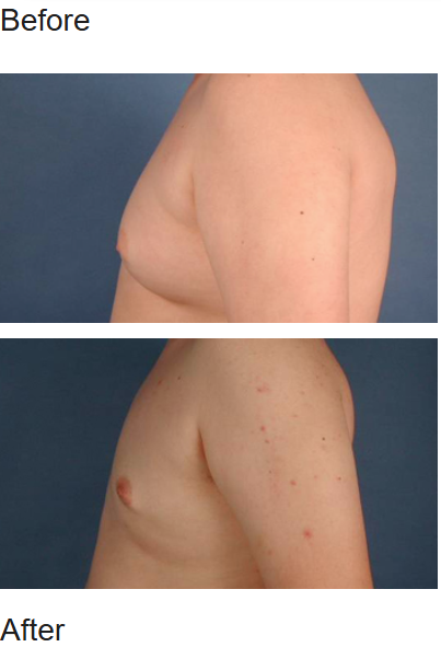 Supplied historical male breast reduction comparison showing side views before above and after below
