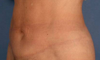 Historical mini tummy tuck photograph, example 1 after surgery, showing an oblique abdominal view.
