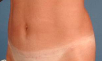 Historical mini tummy tuck photograph, example 2 after surgery, showing a side-oblique abdominal view.