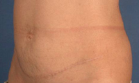 Historical mini tummy tuck photograph, example 3 after surgery, showing the lower abdomen.