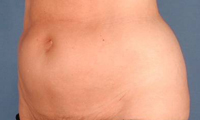 Historical mini tummy tuck photograph, example 1 before surgery, showing an oblique abdominal view.