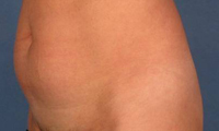 Historical mini tummy tuck photograph, example 2 before surgery, showing a side-oblique abdominal view.