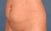 Historical mini tummy tuck photograph, example 3 before surgery, showing the lower abdomen.