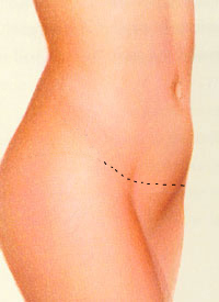 Original surgical illustration showing a possible lower abdominal scar after closure.