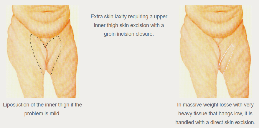 Historical thigh-contouring illustration showing liposuction markings at left and skin-excision markings at right, with text about an upper-inner-thigh excision in the center.